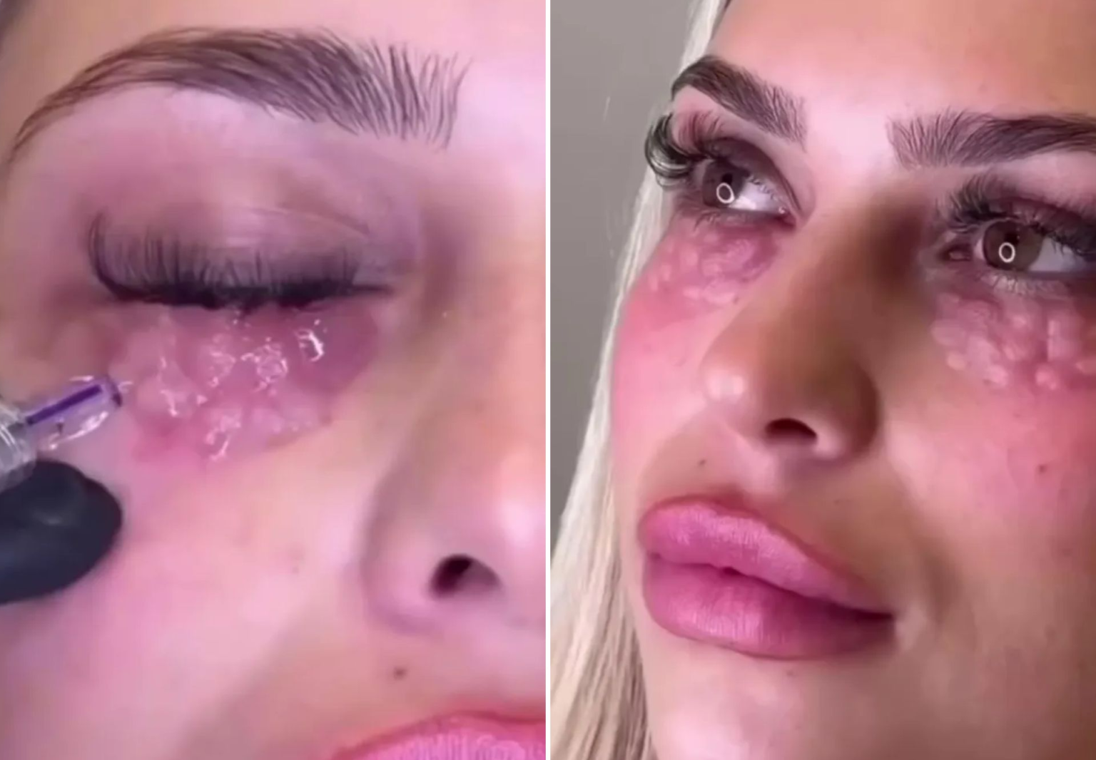 MÉDICOS ALERTAM PARA TRATAMENTO ESTÉTICO PERIGOSO QUE PODE CAUSAR DANOS GRAVES NOS OLHOS